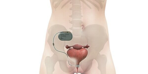 "UroActive smart implant for stress urinary incontinence"