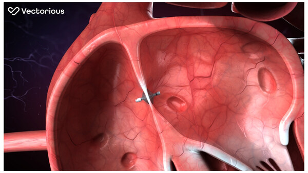 V-LAP heart monitoring system by Vectorious Medical Technologies